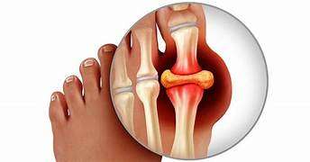 Gout joint