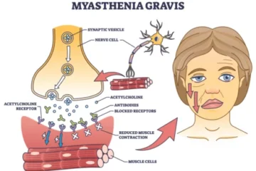 Myasthenia gravis